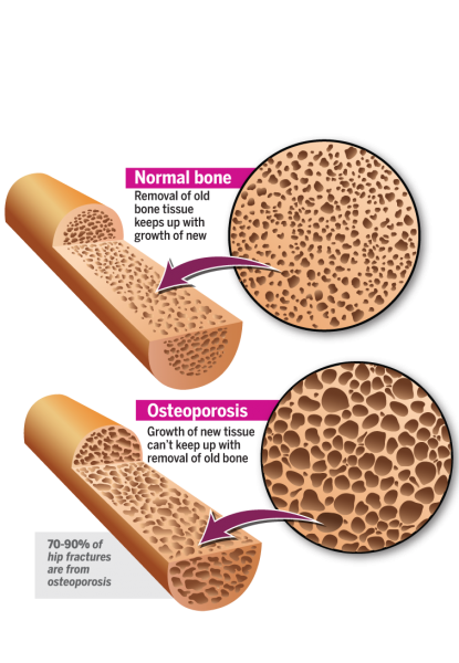 Osteoporoza, boala oaselor fragile: Simptome, tratament, dieta | Bioclinica