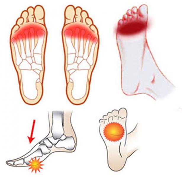 Fasceita plantara – Pinten calcanean, Pinteni între tratamentul degetelor de la picioare